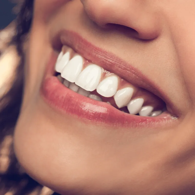 Smile Design in Bursa