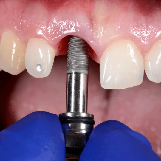 Dental Implants in Bursa