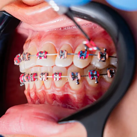 Orthodontics in Bursa