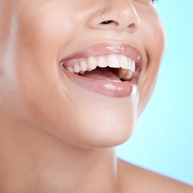 Porcelain Laminate Veneers in Bursa